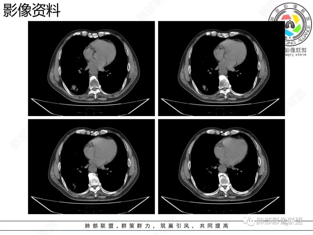 影像PPT - 【病例】胸膜下的混合密度结节—良恶之争-15 影像PPT - 【病例】胸膜下的混合密度结节—良恶之争-15