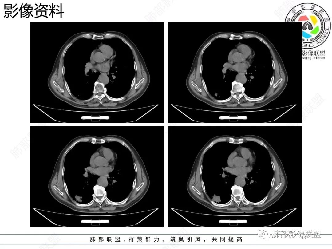 影像PPT - 【病例】胸膜下的混合密度结节—良恶之争-13 影像PPT - 【病例】胸膜下的混合密度结节—良恶之争-13