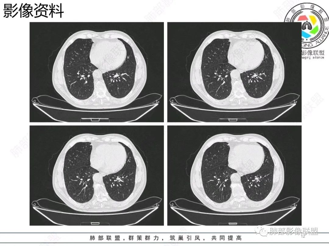 影像PPT - 【病例】胸膜下的混合密度结节—良恶之争-12 影像PPT - 【病例】胸膜下的混合密度结节—良恶之争-12