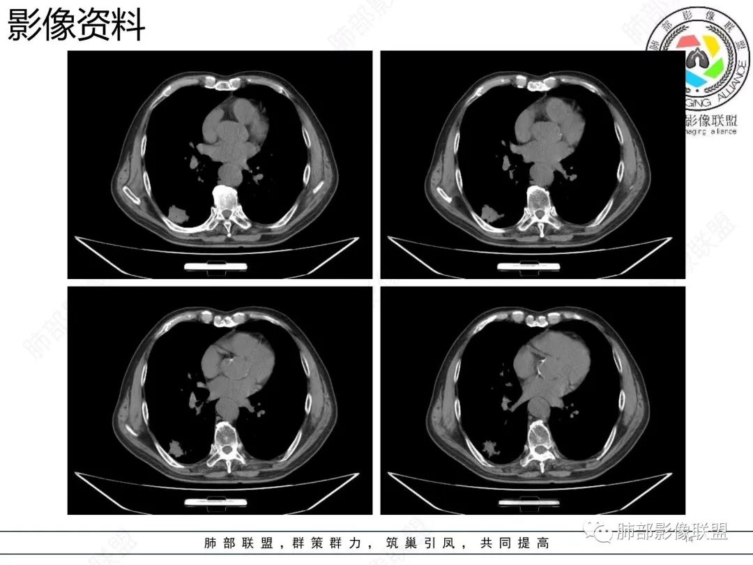 影像PPT - 【病例】胸膜下的混合密度结节—良恶之争-14 影像PPT - 【病例】胸膜下的混合密度结节—良恶之争-14