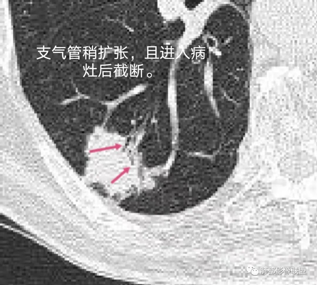 影像PPT - 【病例】胸膜下的混合密度结节—良恶之争-17 影像PPT - 【病例】胸膜下的混合密度结节—良恶之争-17
