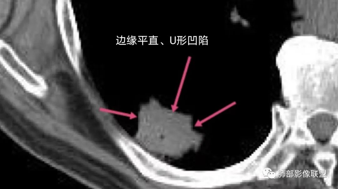 影像PPT - 【病例】胸膜下的混合密度结节—良恶之争-19 影像PPT - 【病例】胸膜下的混合密度结节—良恶之争-19