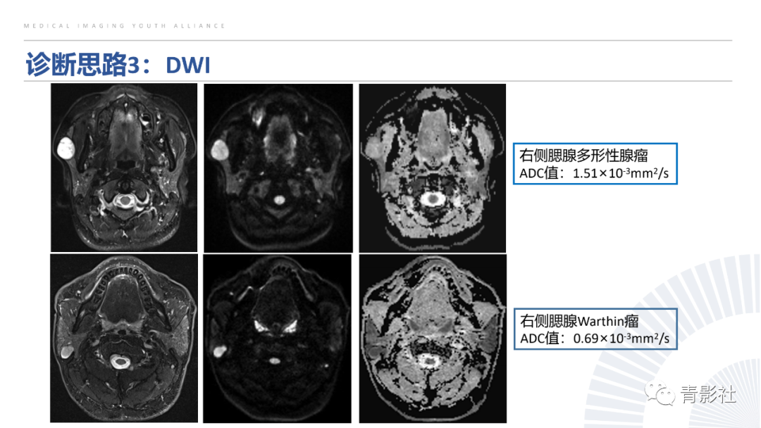 影像PPT - 【PPT】腮腺肿瘤的MRI诊断思路-48