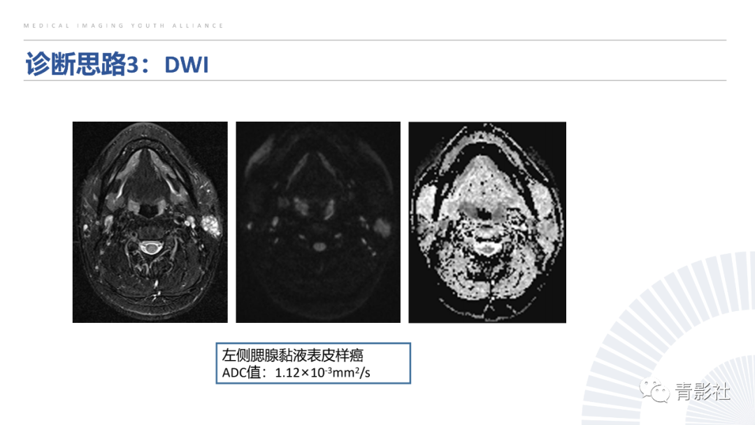 影像PPT - 【PPT】腮腺肿瘤的MRI诊断思路-49
