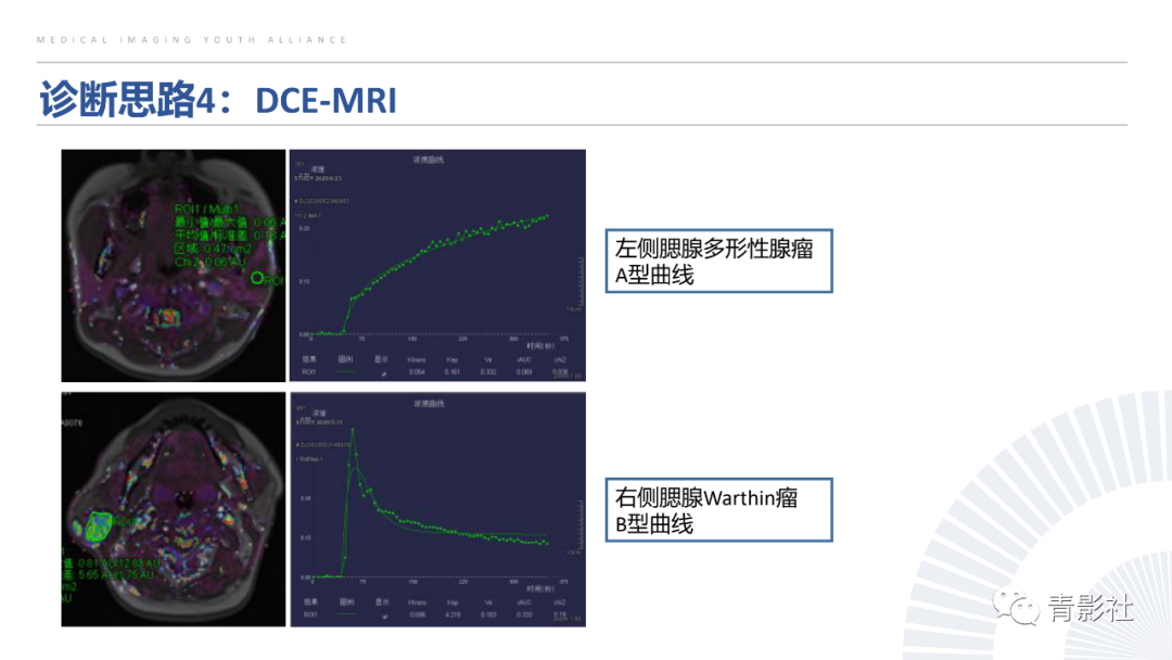 影像PPT - 【PPT】腮腺肿瘤的MRI诊断思路-51
