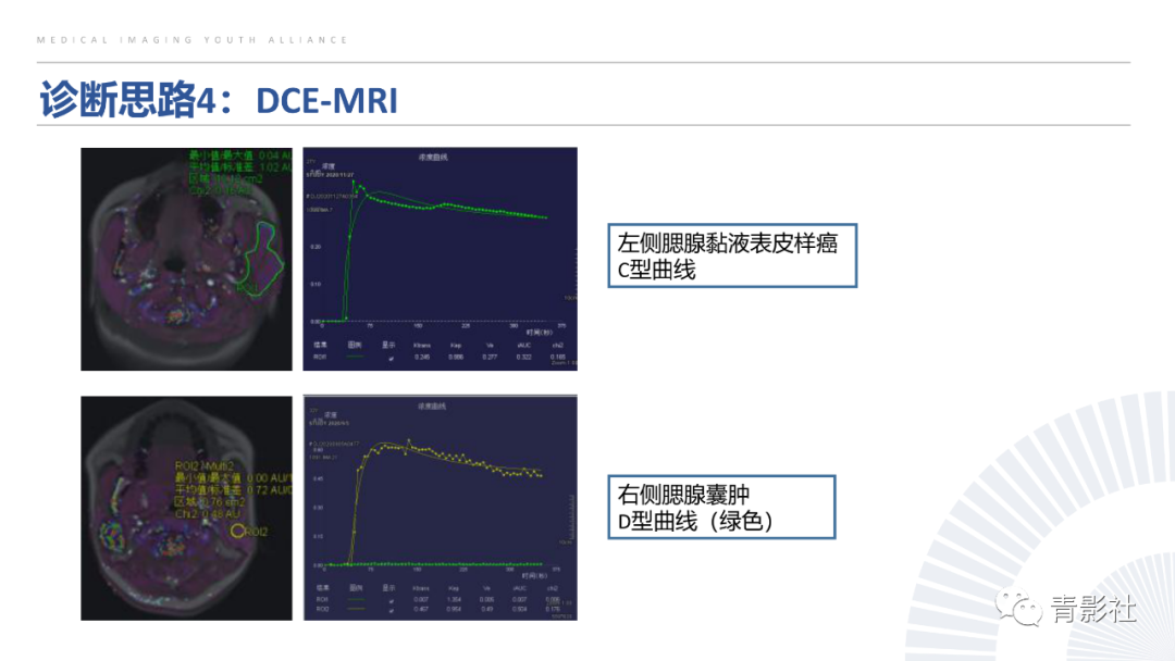 影像PPT - 【PPT】腮腺肿瘤的MRI诊断思路-52
