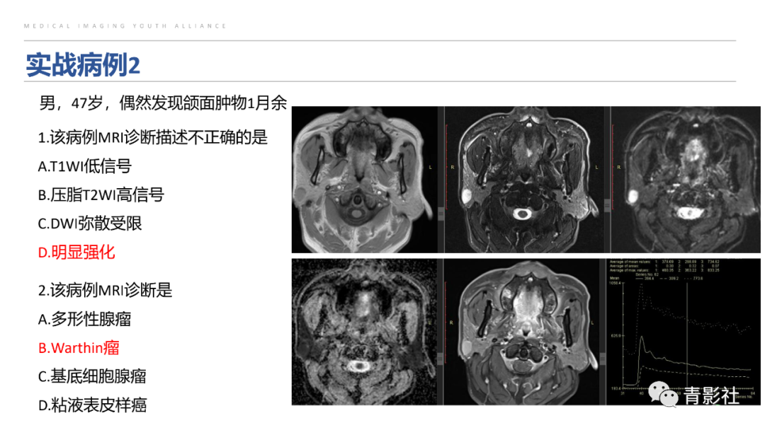 影像PPT - 【PPT】腮腺肿瘤的MRI诊断思路-55