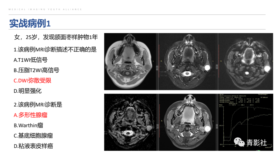 影像PPT - 【PPT】腮腺肿瘤的MRI诊断思路-54