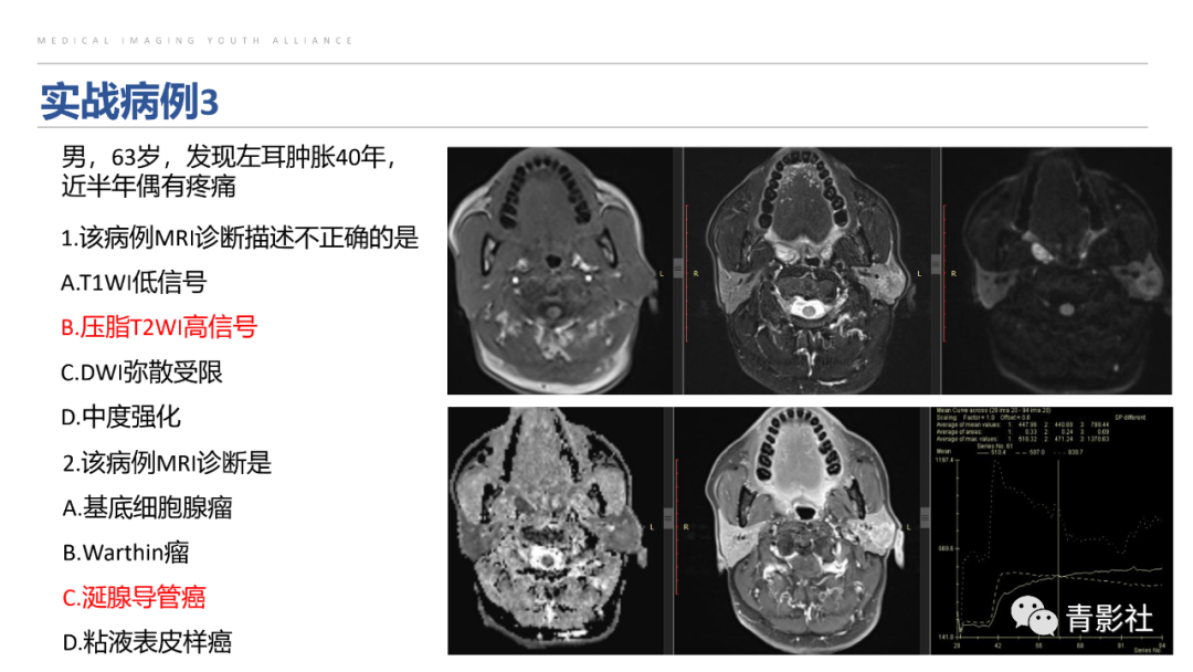 影像PPT - 【PPT】腮腺肿瘤的MRI诊断思路-56