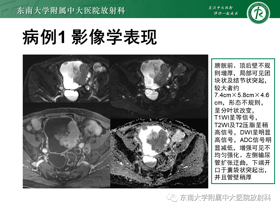 影像PPT - 【PPT】膀胱癌-5 影像PPT - 【PPT】膀胱癌-5