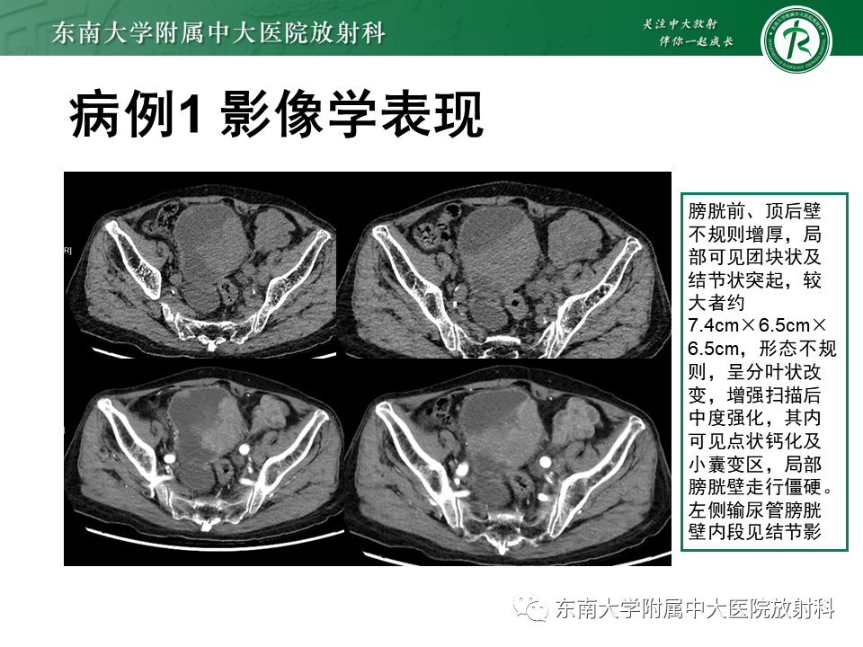 影像PPT - 【PPT】膀胱癌-4 影像PPT - 【PPT】膀胱癌-4