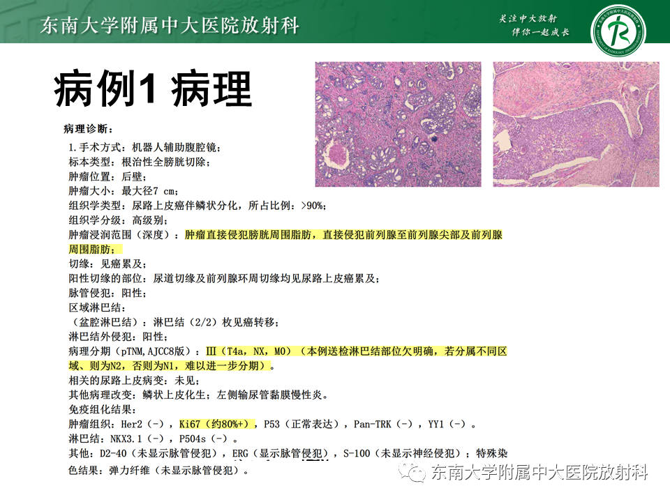 影像PPT - 【PPT】膀胱癌-6 影像PPT - 【PPT】膀胱癌-6