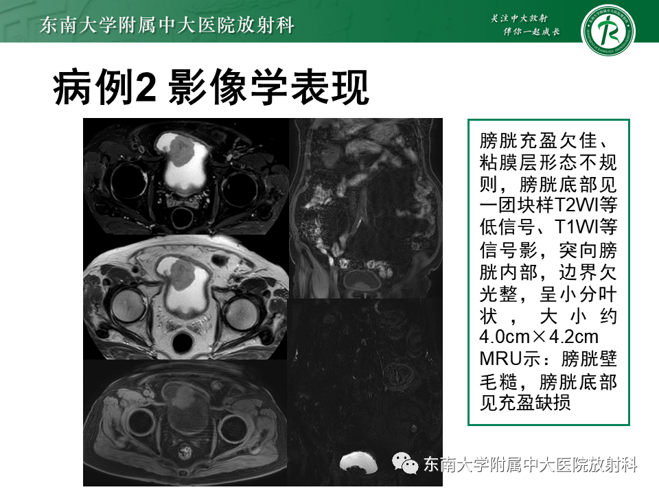 影像PPT - 【PPT】膀胱癌-7 影像PPT - 【PPT】膀胱癌-7