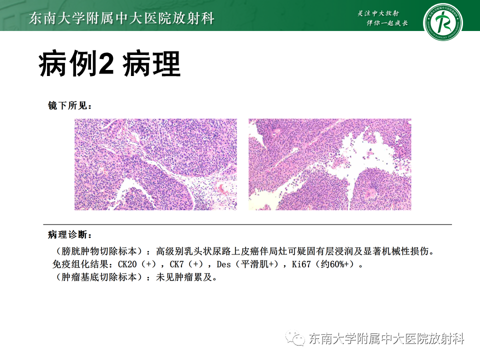 影像PPT - 【PPT】膀胱癌-8 影像PPT - 【PPT】膀胱癌-8