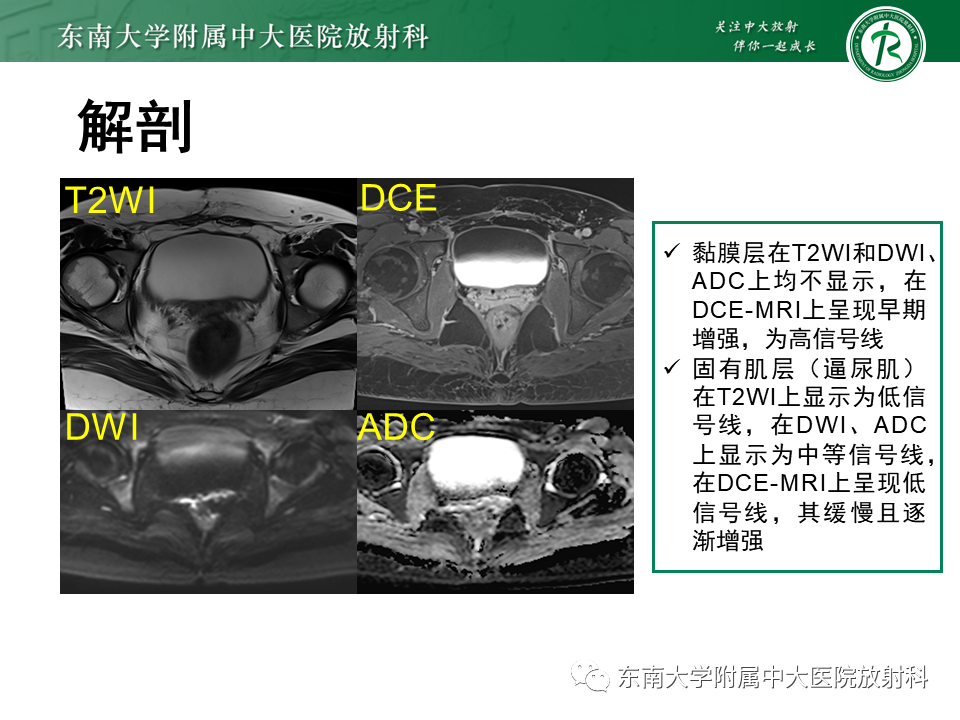 影像PPT - 【PPT】膀胱癌-16 影像PPT - 【PPT】膀胱癌-16