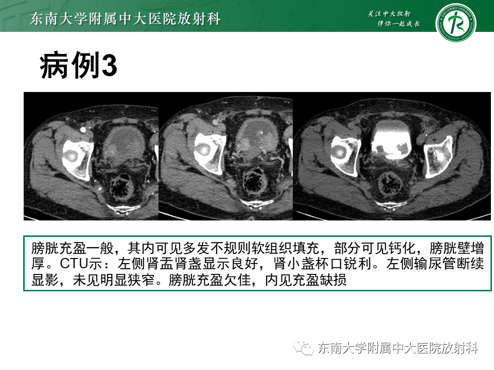 影像PPT - 【PPT】膀胱癌-26 影像PPT - 【PPT】膀胱癌-26