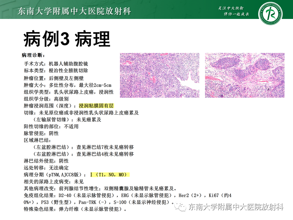 影像PPT - 【PPT】膀胱癌-28 影像PPT - 【PPT】膀胱癌-28