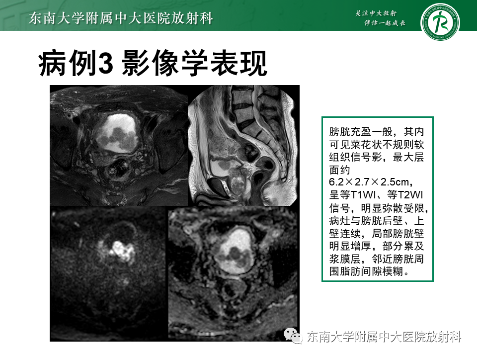 影像PPT - 【PPT】膀胱癌-27 影像PPT - 【PPT】膀胱癌-27