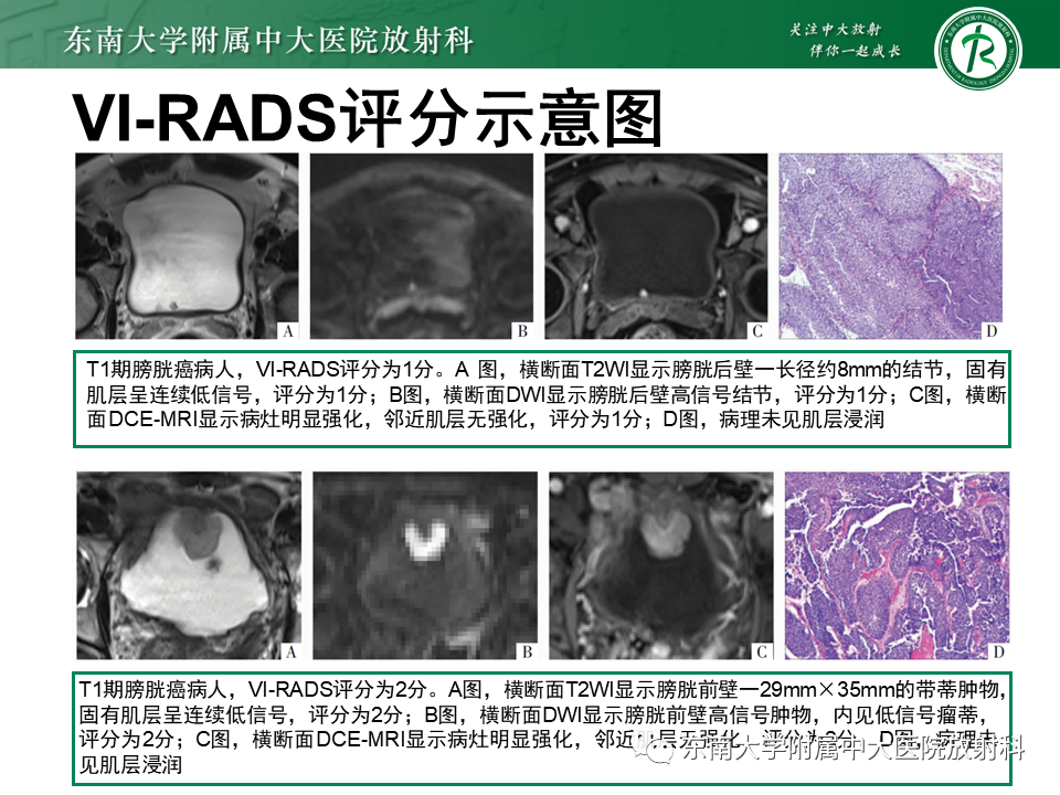 影像PPT - 【PPT】膀胱癌-32 影像PPT - 【PPT】膀胱癌-32