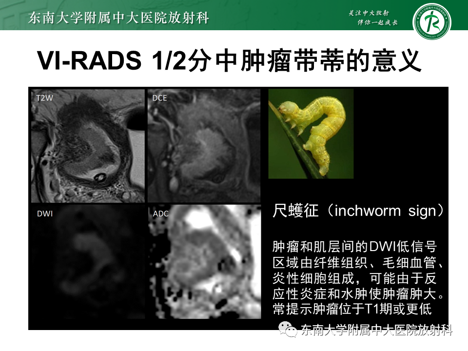 影像PPT - 【PPT】膀胱癌-33 影像PPT - 【PPT】膀胱癌-33