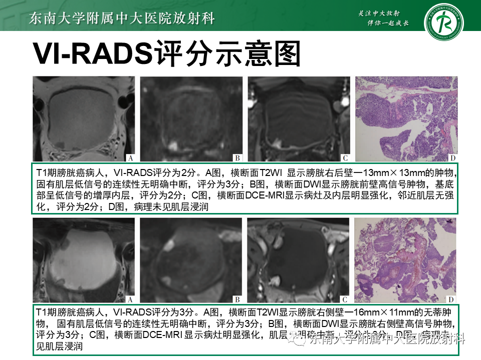 影像PPT - 【PPT】膀胱癌-34 影像PPT - 【PPT】膀胱癌-34