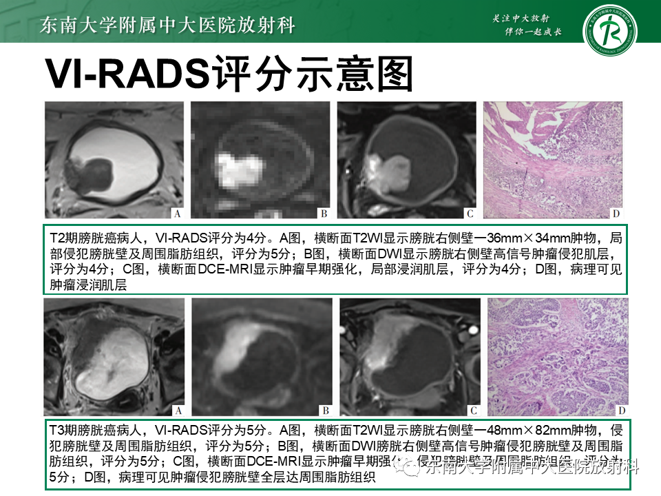 影像PPT - 【PPT】膀胱癌-35 影像PPT - 【PPT】膀胱癌-35
