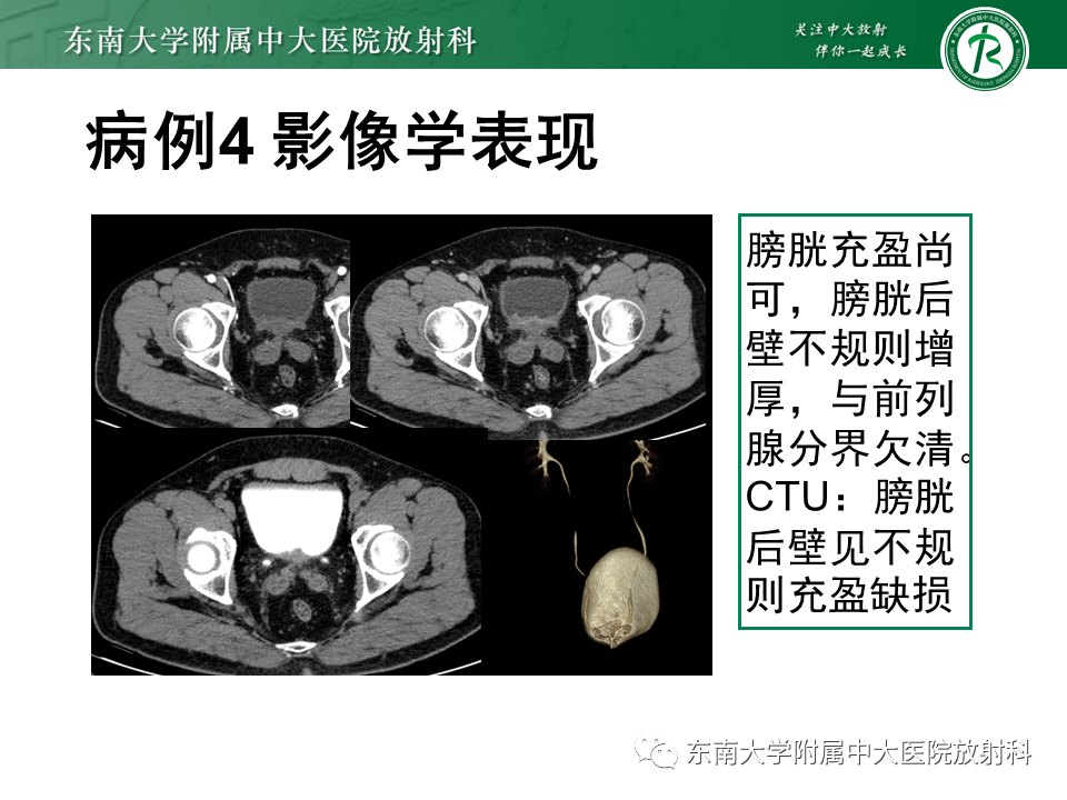 影像PPT - 【PPT】膀胱癌-40 影像PPT - 【PPT】膀胱癌-40