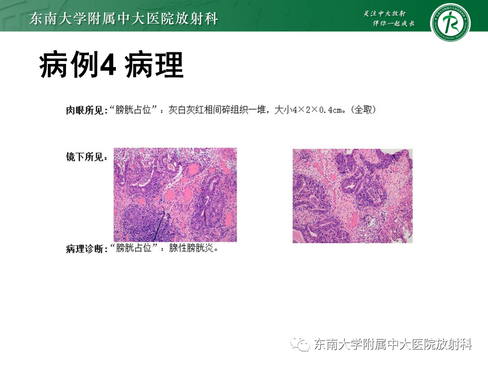 影像PPT - 【PPT】膀胱癌-41 影像PPT - 【PPT】膀胱癌-41