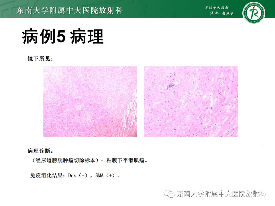 影像PPT - 【PPT】膀胱癌-46 影像PPT - 【PPT】膀胱癌-46
