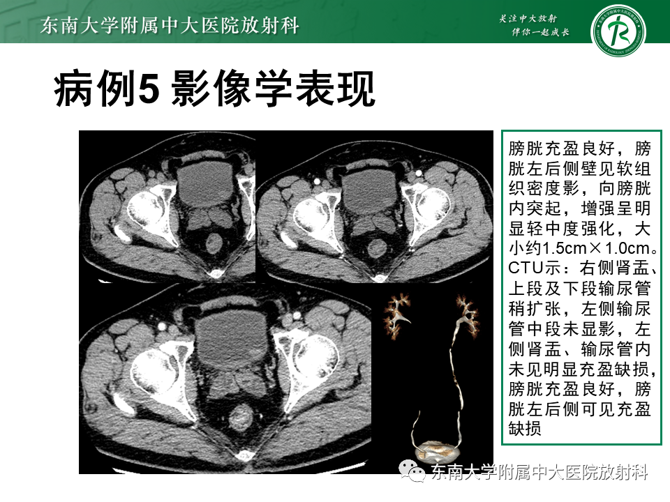 影像PPT - 【PPT】膀胱癌-45 影像PPT - 【PPT】膀胱癌-45