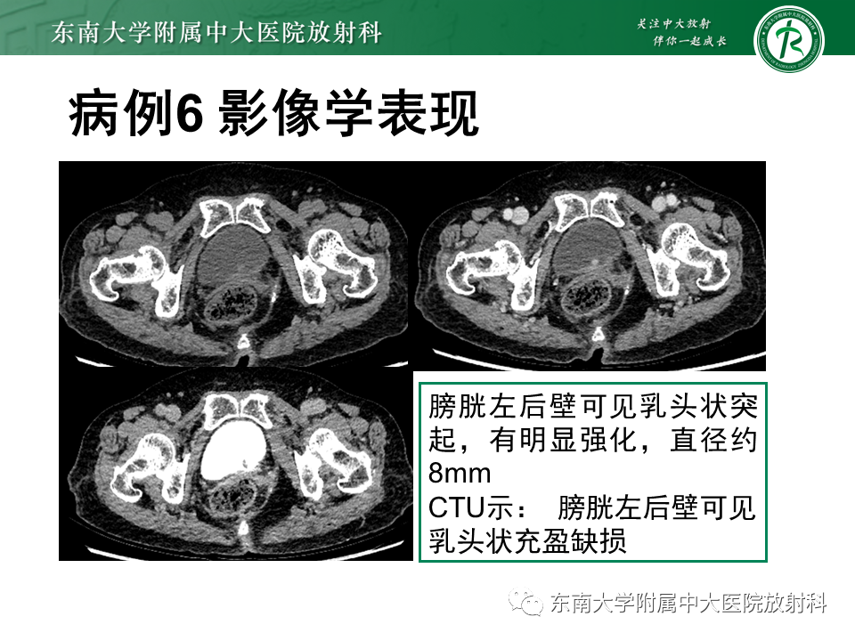 影像PPT - 【PPT】膀胱癌-50 影像PPT - 【PPT】膀胱癌-50