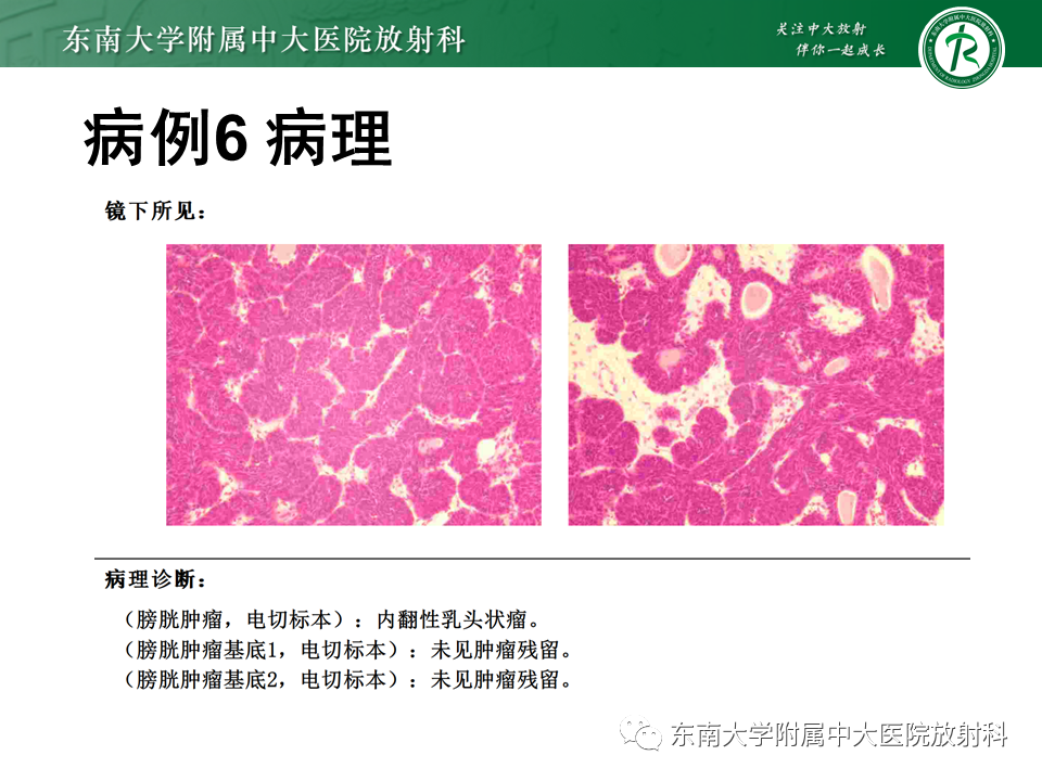 影像PPT - 【PPT】膀胱癌-51 影像PPT - 【PPT】膀胱癌-51