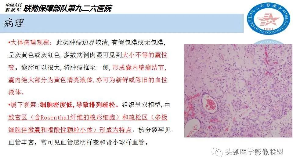 影像PPT - 【PPT】幕下毛细胞型星形细胞瘤的MR分析-5