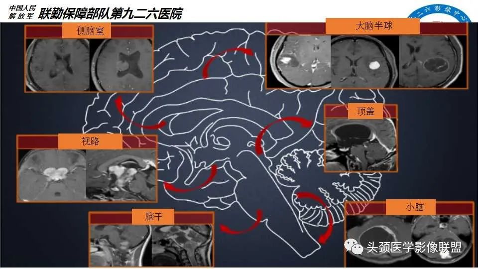 影像PPT - 【PPT】幕下毛细胞型星形细胞瘤的MR分析-7