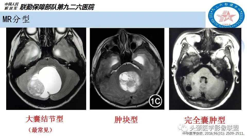 影像PPT - 【PPT】幕下毛细胞型星形细胞瘤的MR分析-9