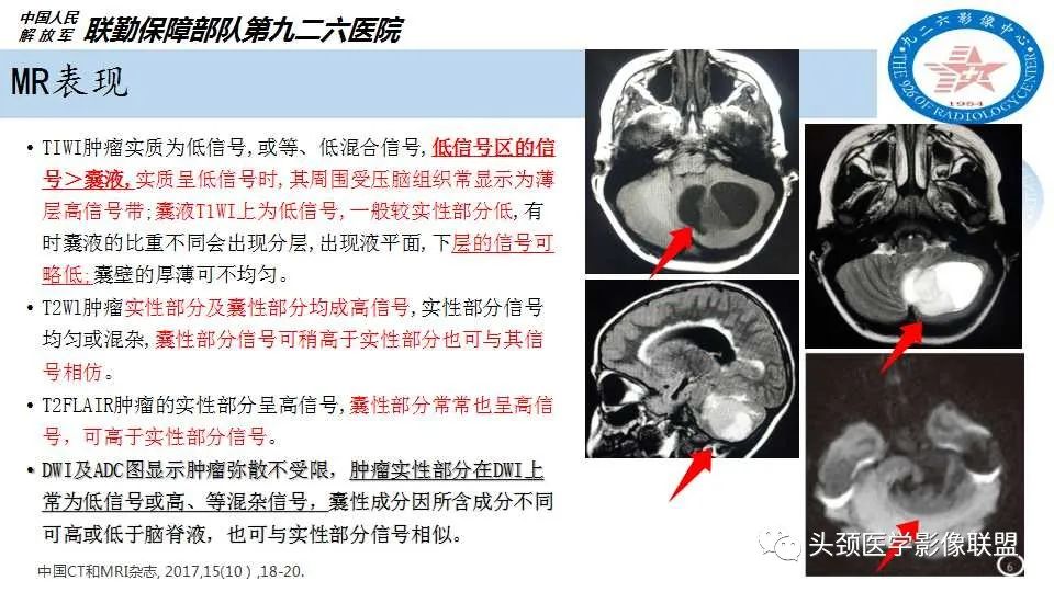 影像PPT - 【PPT】幕下毛细胞型星形细胞瘤的MR分析-10