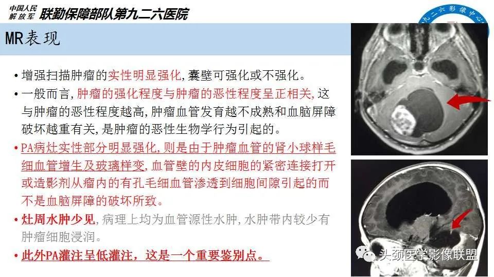 影像PPT - 【PPT】幕下毛细胞型星形细胞瘤的MR分析-11