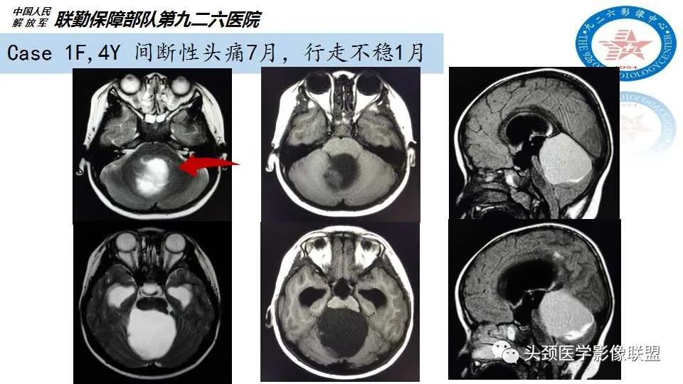 影像PPT - 【PPT】幕下毛细胞型星形细胞瘤的MR分析-14