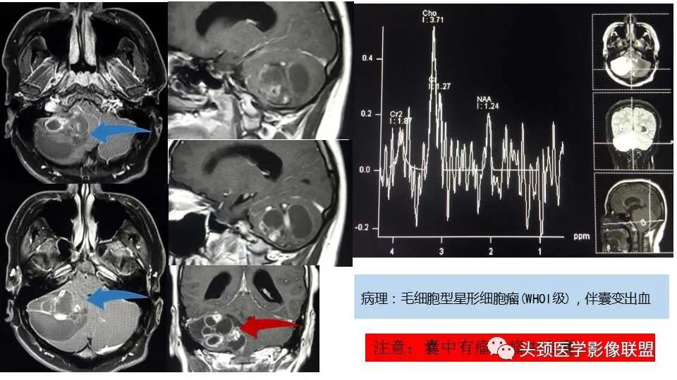 影像PPT - 【PPT】幕下毛细胞型星形细胞瘤的MR分析-17