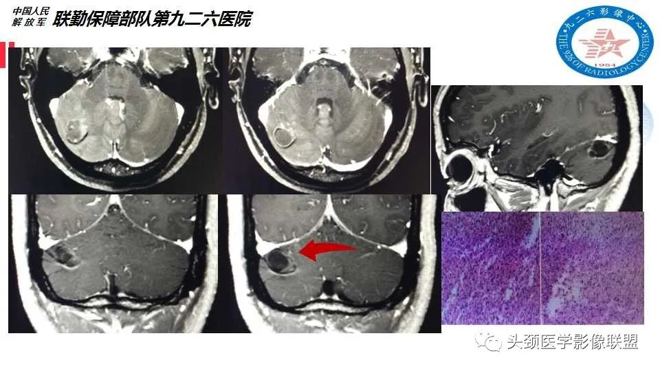 影像PPT - 【PPT】幕下毛细胞型星形细胞瘤的MR分析-19