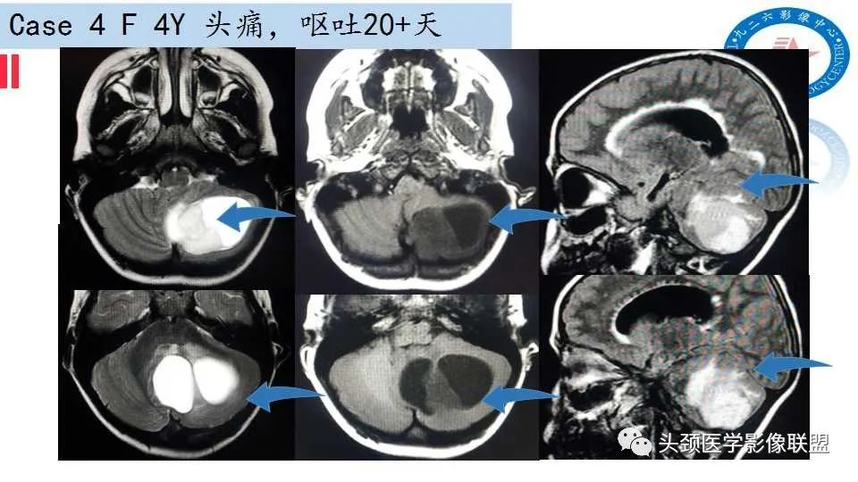 影像PPT - 【PPT】幕下毛细胞型星形细胞瘤的MR分析-20