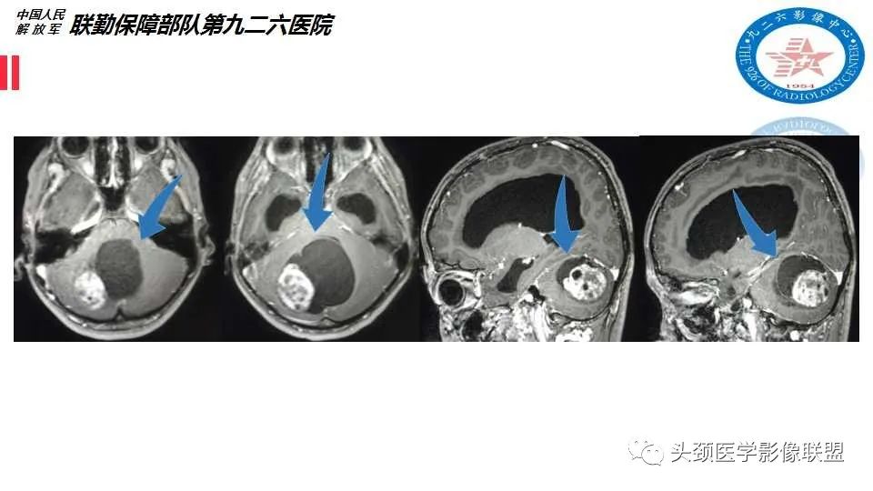 影像PPT - 【PPT】幕下毛细胞型星形细胞瘤的MR分析-23