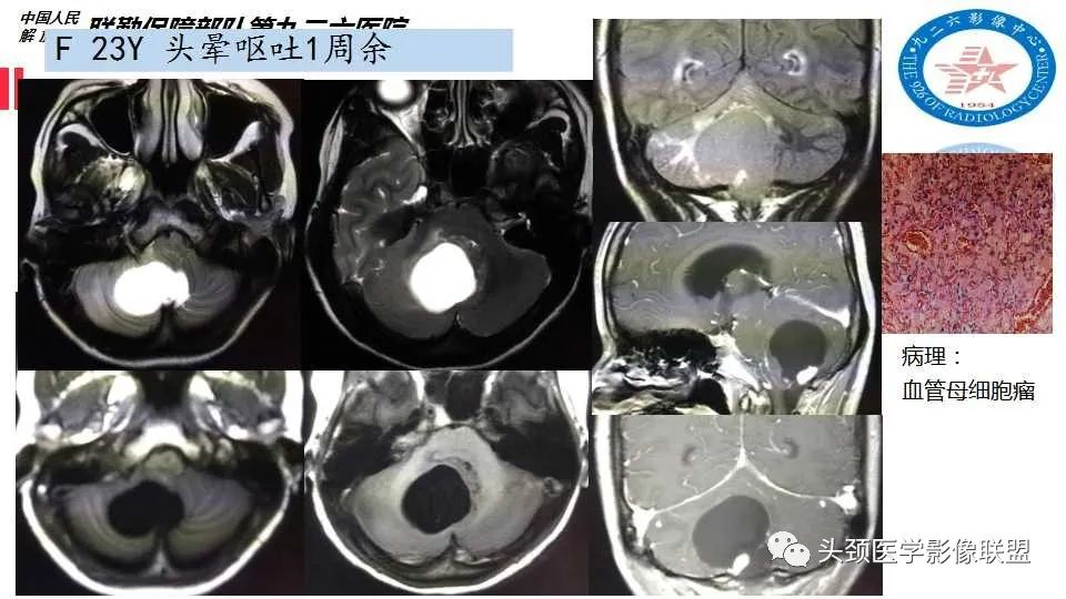 影像PPT - 【PPT】幕下毛细胞型星形细胞瘤的MR分析-26