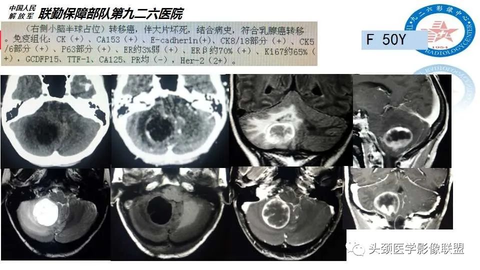 影像PPT - 【PPT】幕下毛细胞型星形细胞瘤的MR分析-35