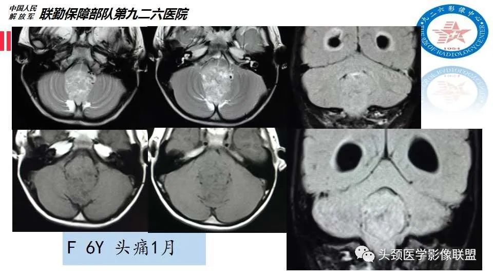 影像PPT - 【PPT】幕下毛细胞型星形细胞瘤的MR分析-30