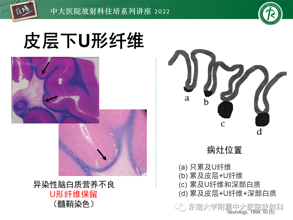 影像PPT - 【PPT】皮层下U形纤维受累常见病变-4