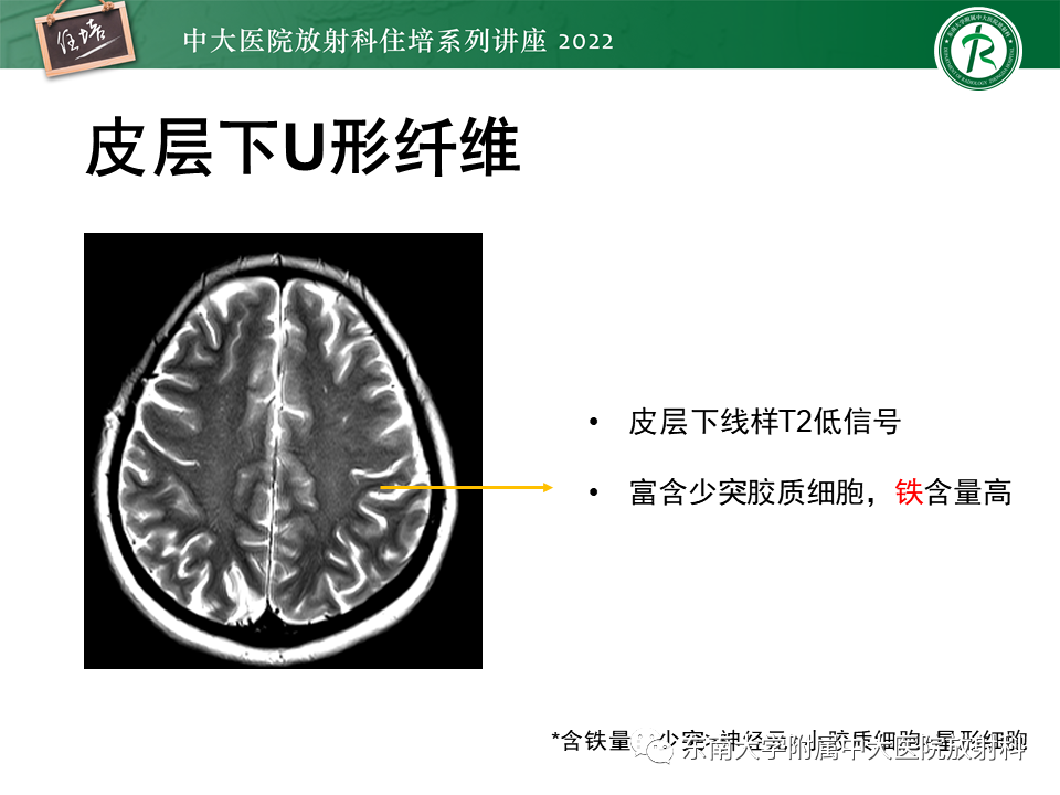 影像PPT - 【PPT】皮层下U形纤维受累常见病变-5