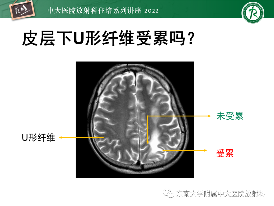 影像PPT - 【PPT】皮层下U形纤维受累常见病变-6