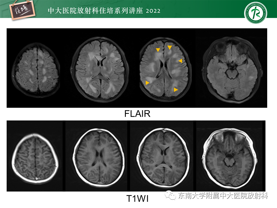 影像PPT - 【PPT】皮层下U形纤维受累常见病变-13