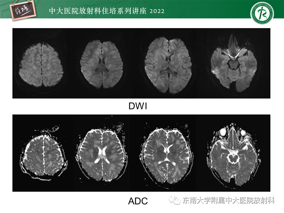 影像PPT - 【PPT】皮层下U形纤维受累常见病变-14